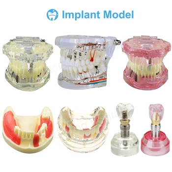 Стоматологическая модель зуба Имплантат со Съемным зубом Обучающая модель для стоматолога Демонстрация Общения с пациентом Стоматологические продукты